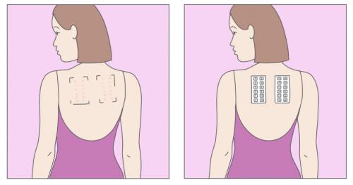 Можно ли предотвратить появление морщинки вокруг глаз