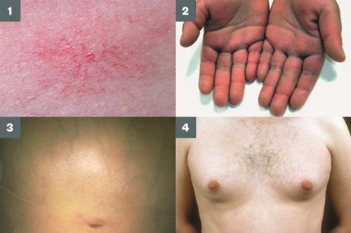 Функции печени В нормализации избыточного веса. Причины возникновения жировой болезни печени 01