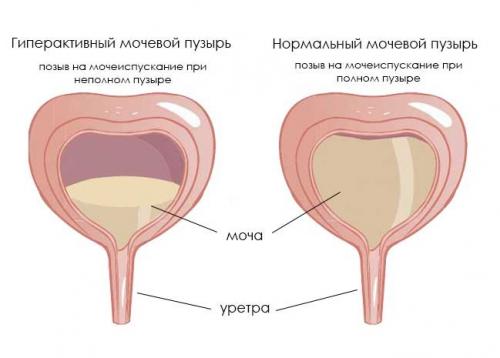 Инфекция мочевых путей в пожилом возрасте. Бактериальные неосложненные инфекции мочевыводящих путей 01 Инфекция мочевых путей в пожилом возрасте. Бактериальные неосложненные инфекции мочевыводящих путей 01