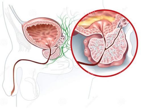 Как вылечить аденому предстательной железы. Современные методики лечения аденомы простаты 05