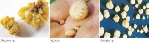 Можно ли растворить камни в почках. Как вывести камни из почек без операции: эффективные методы лечения 04 Можно ли растворить камни в почках. Как вывести камни из почек без операции: эффективные методы лечения 04