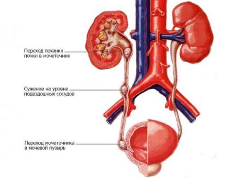 Можно ли растворить камни в почках. Как вывести камни из почек без операции: эффективные методы лечения 08 Можно ли растворить камни в почках. Как вывести камни из почек без операции: эффективные методы лечения 08