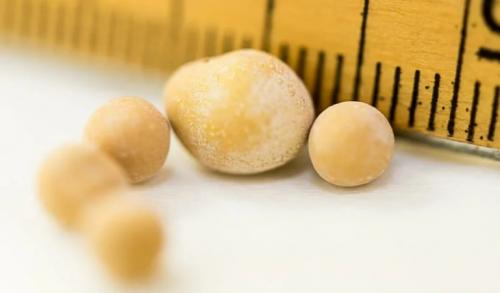 Можно ли растворить камни в почках. Как вывести камни из почек без операции: эффективные методы лечения 05 Можно ли растворить камни в почках. Как вывести камни из почек без операции: эффективные методы лечения 05