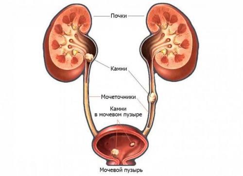Можно ли растворить камни в почках. Как вывести камни из почек без операции: эффективные методы лечения 07 Можно ли растворить камни в почках. Как вывести камни из почек без операции: эффективные методы лечения 07