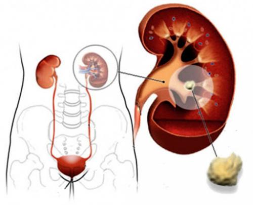 Как долго выходят камни из почек и могут ли они растворяться. После выхода камня болит почка: как долго длится состояние и нужна ли помощь врача 07