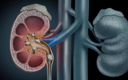 Как долго выходят камни из почек и могут ли они растворяться. После выхода камня болит почка: как долго длится состояние и нужна ли помощь врача 11 Как долго выходят камни из почек и могут ли они растворяться. После выхода камня болит почка: как долго длится состояние и нужна ли помощь врача 11