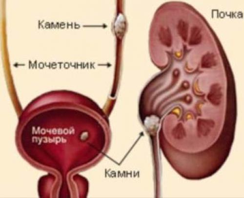 Как долго выходят камни из почек и могут ли они растворяться. После выхода камня болит почка: как долго длится состояние и нужна ли помощь врача 04