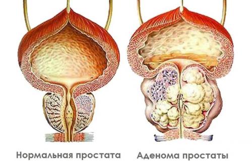 Самое эффективное лечение аденомы простаты. Все об аденоме простаты и новационных методах ее лечения