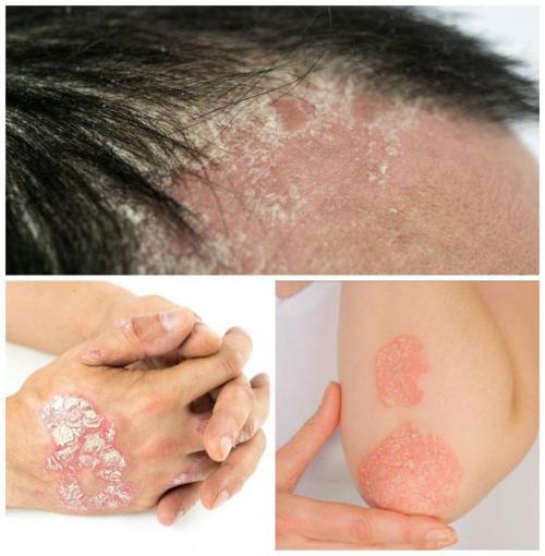 Псориаз и современные методы его лечения. Эффективность менее современных методов лечения псориаза 02