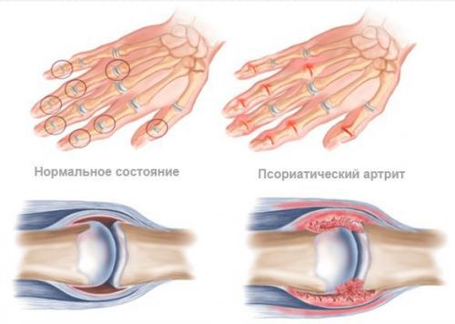 Псориаз и современные методы его лечения. Эффективность менее современных методов лечения псориаза 01