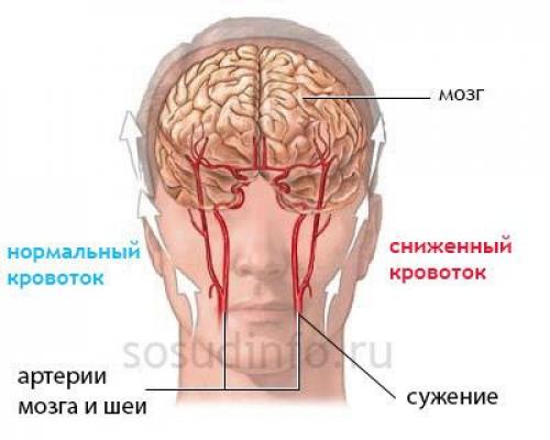 Альтернатива лекарствам при атеросклерозе артерий. Классификации болезни, ее виды и стадии 01