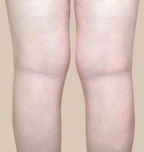 Как избавиться от сосудистых звёздочек. Сосудистые звездочки 01 Как избавиться от сосудистых звёздочек. Сосудистые звездочки 01