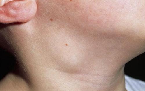 Почему воспаляются лимфоузлы на шее. Определение болезни. Причины заболевания 04