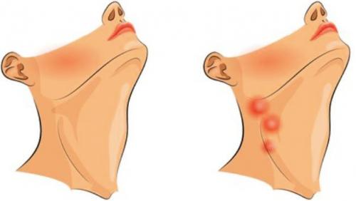Почему воспаляются лимфоузлы на шее. Определение болезни. Причины заболевания 02
