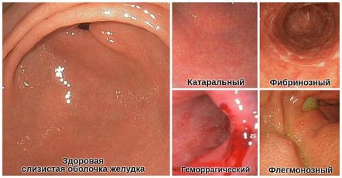 Как восстановить защитные свойства желудка.. Классификация и стадии развития атрофического гастрита 05
