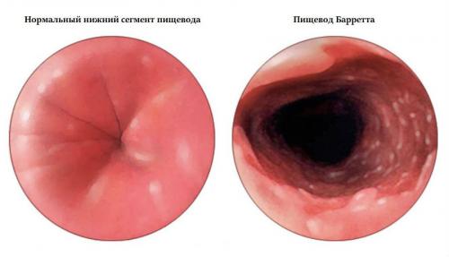Как восстановить защитные свойства желудка.. Классификация и стадии развития атрофического гастрита 02