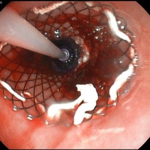 Питание для профилактики и лечения панкреатита. Зачем соблюдать диету 04