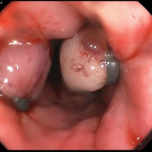 Питание для профилактики и лечения панкреатита. Зачем соблюдать диету 05