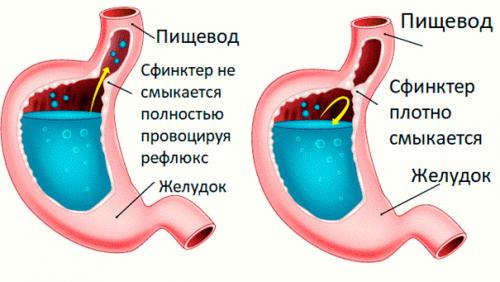 Опыт лечения гастроэзофагеальной рефлюксной болезни. Терапевтические аспекты гастроэзофагеальной рефлюксной болезни 04
