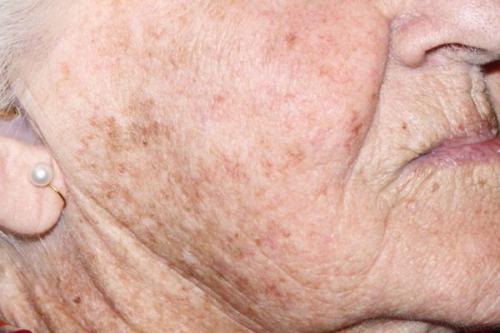 Как убрать возрастные пигментные пятна. Старческие пятна на лице: лечение 08