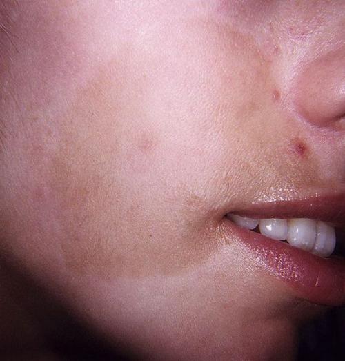 Как убрать возрастные пигментные пятна. Старческие пятна на лице: лечение 09