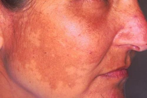 Как убрать возрастные пигментные пятна. Старческие пятна на лице: лечение 04