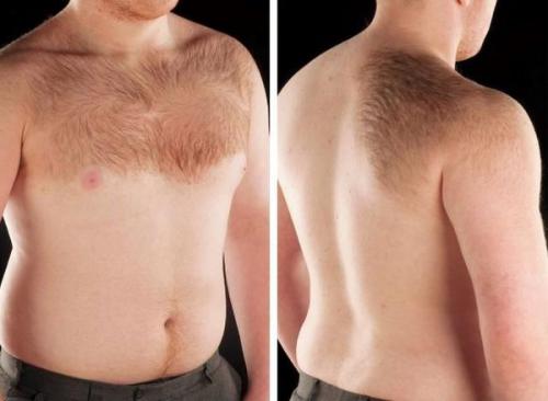 Как убрать возрастные пигментные пятна. Старческие пятна на лице: лечение 05