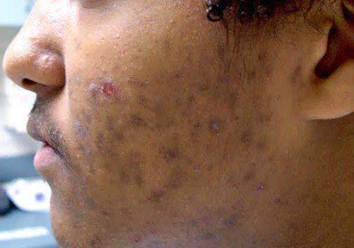 Как убрать возрастные пигментные пятна. Старческие пятна на лице: лечение 06