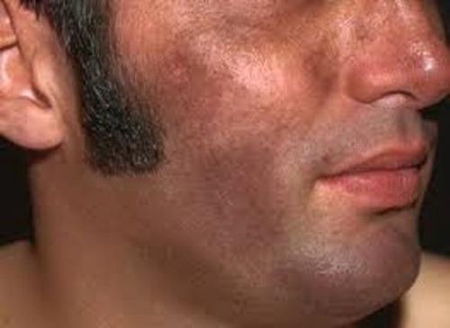 Как убрать возрастные пигментные пятна. Старческие пятна на лице: лечение 10